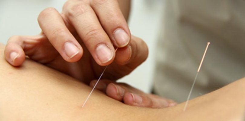 Acupuntura en Barcelona